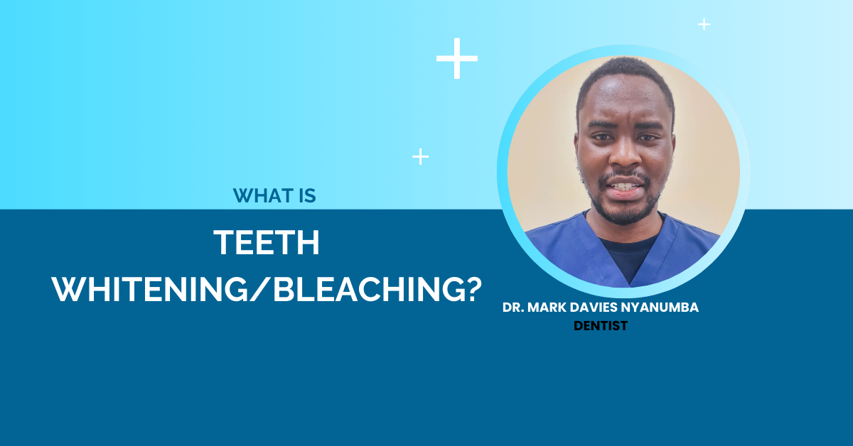 What is teeth whitening/bleaching?