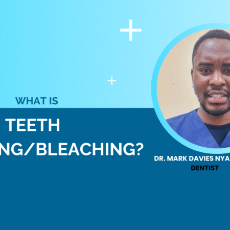 What is teeth whitening/bleaching?